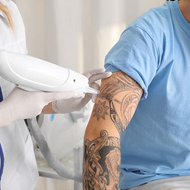 tattoo removal procedure at a tattoo shop