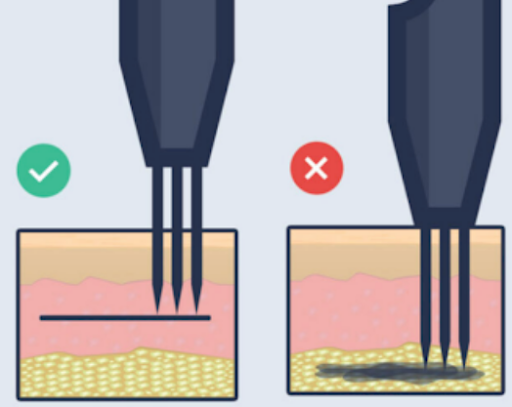 ink in the dermis layer ink in the dermis layer