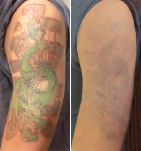 remove tattoo qualified medical practitioner removed a tattoo